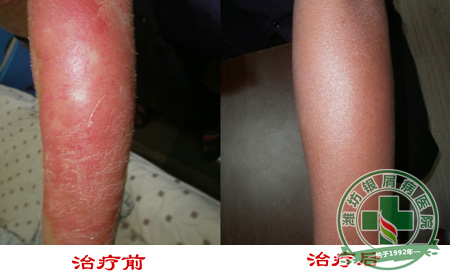 醫生忠告:牛皮癬治療不要走彎路