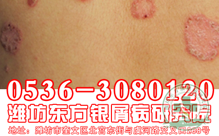 牛皮癬的治療方法-輔助治療