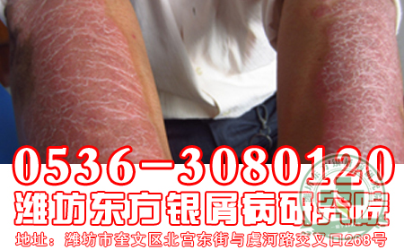 牛皮癬日常護理一定要注意