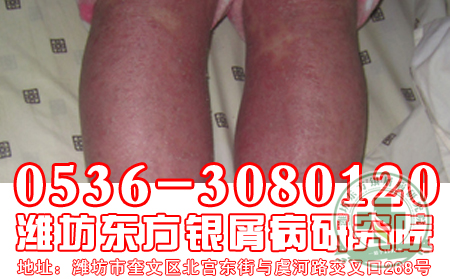 早期紅皮型牛皮癬如何診斷