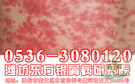 牛皮癬患者經常泡腳會對牛皮癬的治療有輔助作用嗎