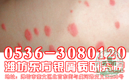 點滴型牛皮癬治療期間消退是什么癥狀