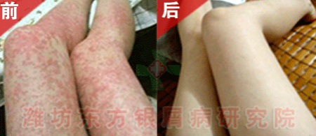 銀屑病醫院醫生簡述牛皮癬如何治療方法理想健康