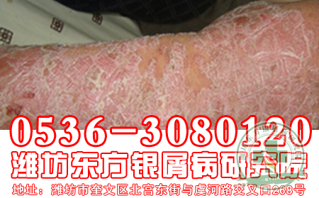 膿皰型牛皮癬怎么治療?