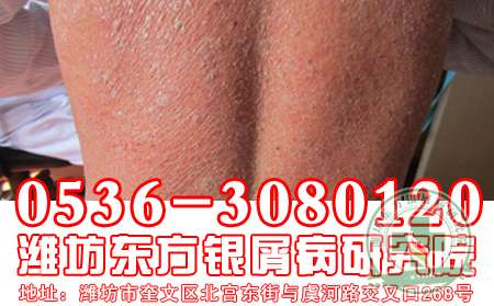 濟南牛皮癬醫(yī)院醫(yī)生解答全身性牛皮癬