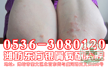 牛皮癬患者可不理想吃燒烤?