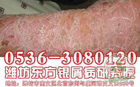 環(huán)境惡化也能引起牛皮癬?