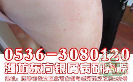 春季治療銀屑病理想時節(jié)