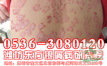 濟(jì)南牛皮癬醫(yī)院醫(yī)生解析牛皮癬治療有什么要求