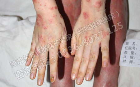 剛患上牛皮癬怎么治療不會加重病情