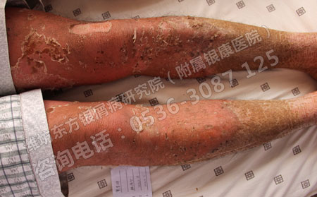 尋常型牛皮癬轉型后會造成什么樣的危害