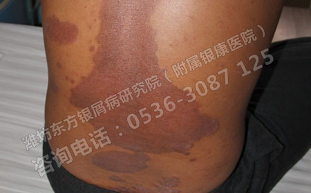 怎么治療牛皮癬才算正規