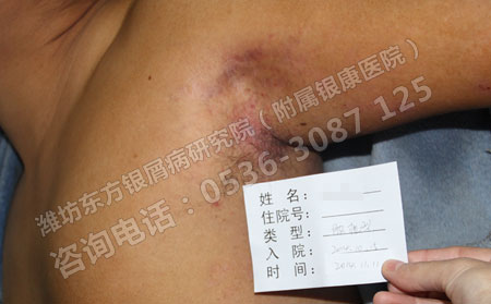 銀屑病可分為哪幾種類型