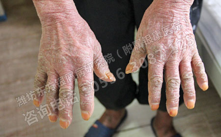 牛皮癬關節炎怎么治療能治理想