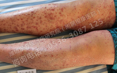 中醫(yī)辨證講述牛皮癬的治病原理