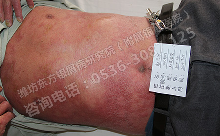 全身牛皮癬的護理辦法是什么