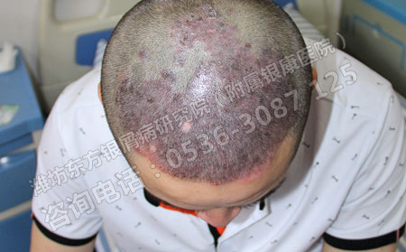 兒童得了牛皮癬之后要怎樣治療理想