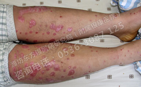 牛皮癬不治療會有什么后果?