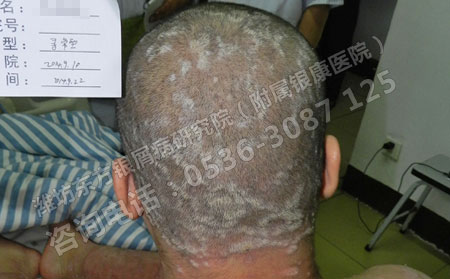 頭部出現牛皮癬怎么治療理想？