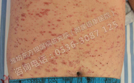 銀屑病高發(fā)的原因是什么呢