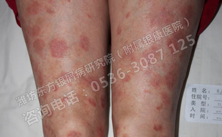 孕婦牛皮癬患者要注意什么
