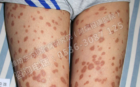 銀屑病會對女性患者造成哪些危害?