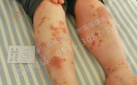 銀屑病治療有什么小妙招嗎