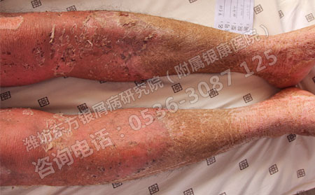 男性牛皮癬理想治嗎?去哪里治