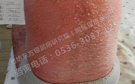 濟南銀屑病醫院治療銀屑病的優點