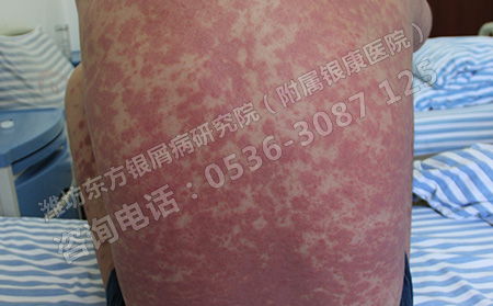 銀屑病的發生會給人體造成哪些危害