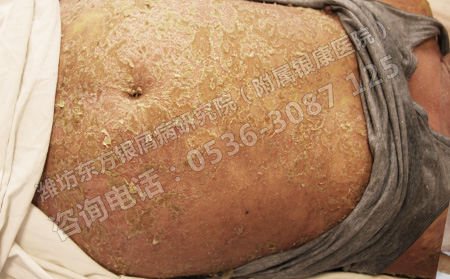 女性銀屑病有哪些危害