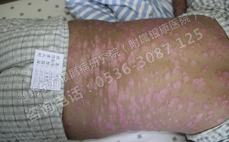 銀屑病治療有什么準則