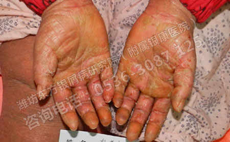 女性銀屑病患者如何健康生活
