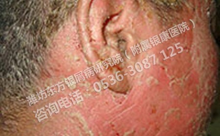 臉部銀屑病有什么癥狀