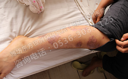 兒童銀屑病如何護理