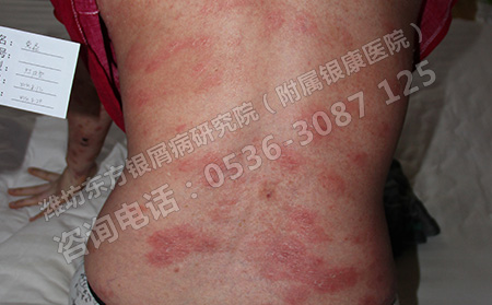 預防銀屑病的方法都有哪些