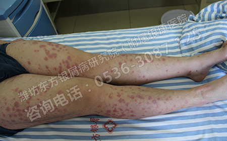女性銀屑病患者在生理期如何護理