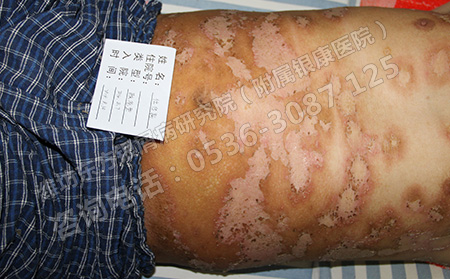 銀屑病如果不及時(shí)治療會(huì)有哪些危害