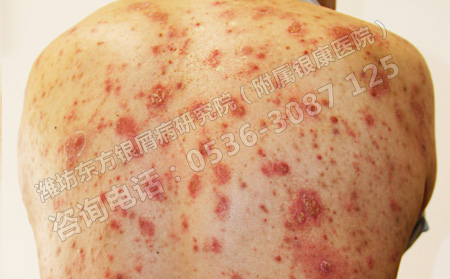 老年銀屑病的治療存在哪些誤區
