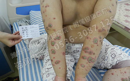 女性銀屑病要注意哪些問題