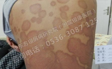 濟南銀屑病的理想治療效果源于哪里