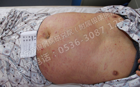 治療銀屑病有沒有治療方法理想的方法