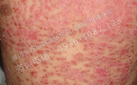 兒童銀屑病要避免那些治療誤區