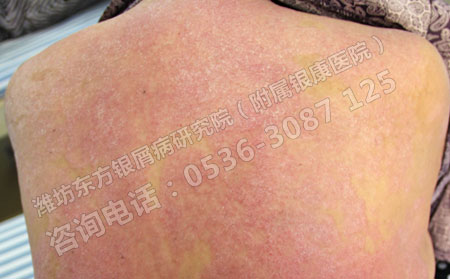 牛皮癬患者全身發病的原因是什么
