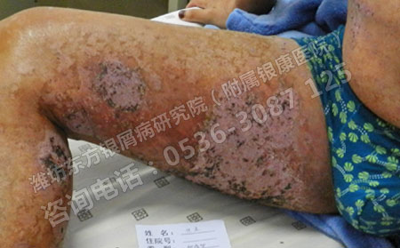 五一將至，銀屑病患者假期出行如何護(hù)膚