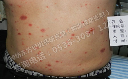銀屑病臨床治療有三招
