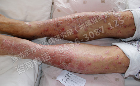 孩子得了銀屑病要如何有效治療