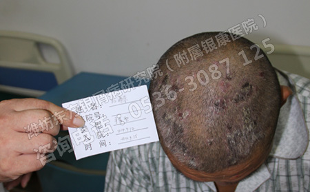 怎樣才能及時有效的預防銀屑病的發生