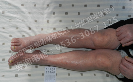 得了銀屑病怎樣護(hù)理才能避免復(fù)發(fā)呢