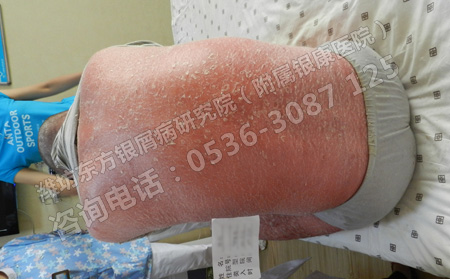 尋常型銀屑病患者身體過敏了怎么辦呢